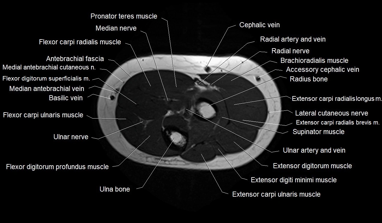 MRI 3T forearm axial cross sectional anatomy image 14.webp